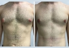 Gynecomastia in Dubai for Teenagers: When Should You Consider Treatment?