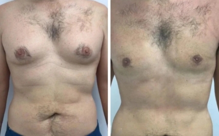 Why Men from Around the World Travel for Gynecomastia Surgery in Dubai