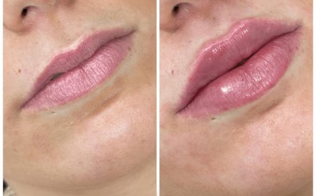 Juvederm Treatment in Dubai for Marionette Lines
