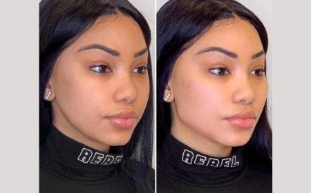 Thread Lift Treatments in Dubai: How Safe Are They and What Are the Aftercare Tips