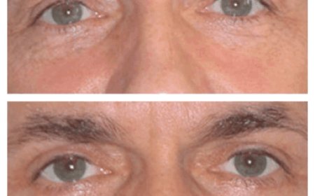How to Sleep After Eye Bag Removal Surgery in Dubai