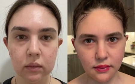 Why Celebrities Trust the Best Buccal fat removal Surgeons in Dubai