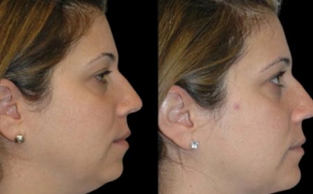What supplements support healing after Double chin removal surgery in Dubai