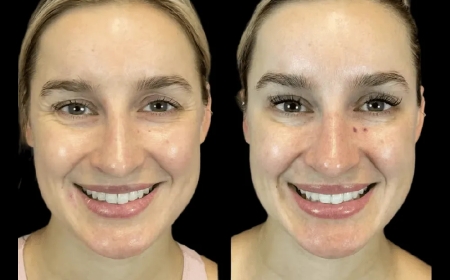 Latest Advancements in Botox Treatment in Dubai You Should Know