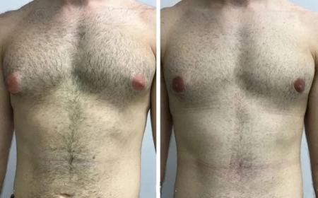 Gynecomastia in Dubai for Teenagers: When Should You Consider Treatment?