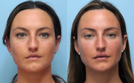 Achieve Youthful Tightness with the Best Plastic Surgeon in Dubai for Thread Lift