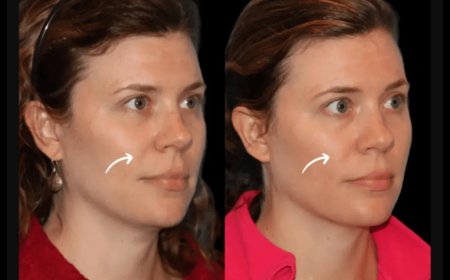 Best Aesthetic Clinic in Dubai for Long-Lasting Fillers