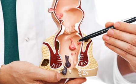 Piles Doctor Mumbai: Your Ultimate Guide to Hemorrhoid Treatment and Care