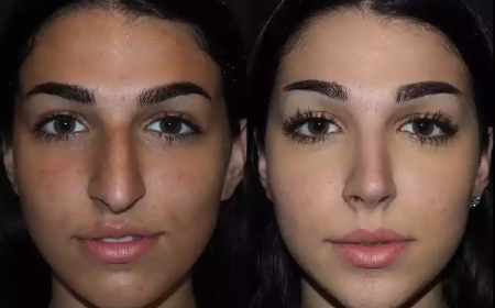 How to Prepare for Rhinoplasty in Dubai