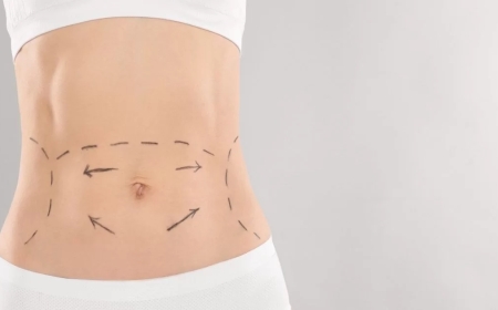 Abdominoplasty in Dubai: What You Need to Know Before the Procedure