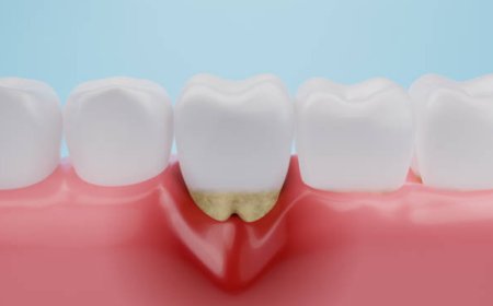 Gingivitis Prevention Stops Bleeding Gums and Bad Breath