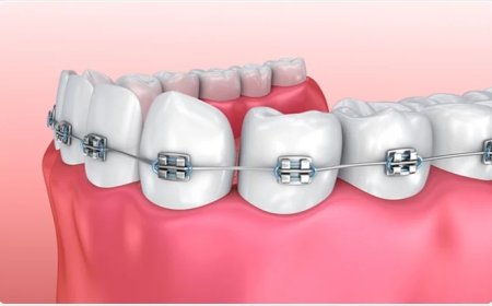 Cost Influencing Factor for Dental Braces