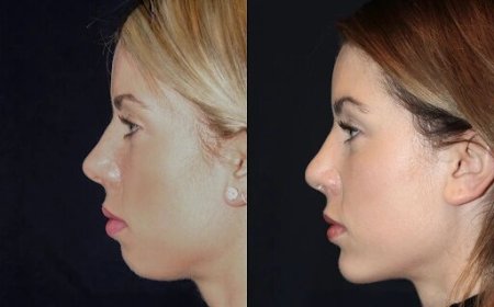 Chin Fillers in Dubai: What You Should Know About Recovery