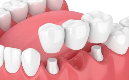 Gezond Tandvlees: Waarom Tijdige Behandeling van Tandvleesproblemen Cruciaal Is