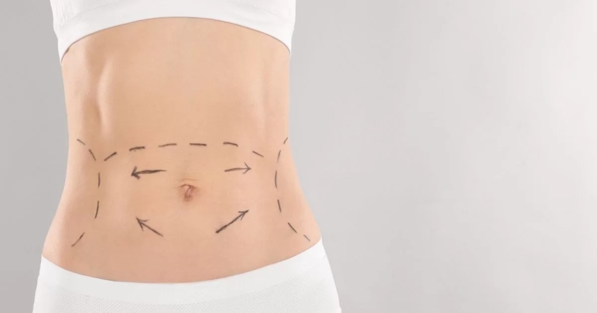 Abdominoplasty in Dubai: What You Need to Know Before the Procedure