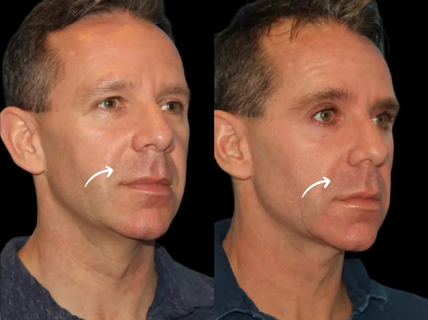 Sculptra Treatment in Dubai: Fibroblast Action
