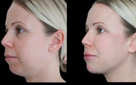 Recovery Tips after Jawline Fillers Treatment in Dubai