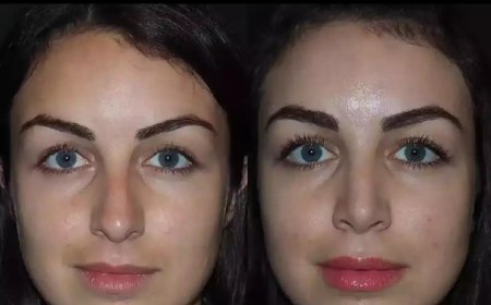 Best Septoplasty Surgeon in Dubai for Long-Term Breathing Relief