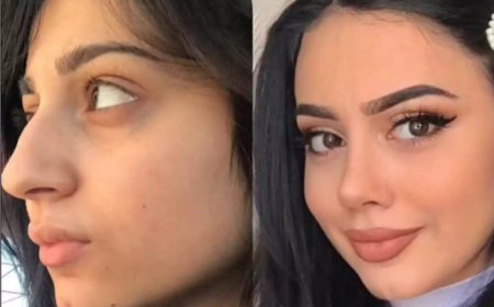 Best Rhinoplasty Surgeon in Dubai: Crafting Faces with Precision