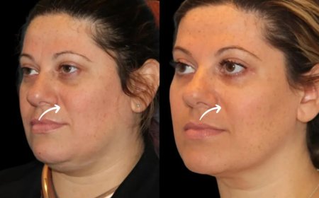 Sculptra Treatment in Dubai for Defined Contours