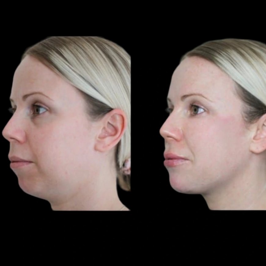Jawline Fillers for Younger Appearance at the Best Aesthetic Clinic in Dubai