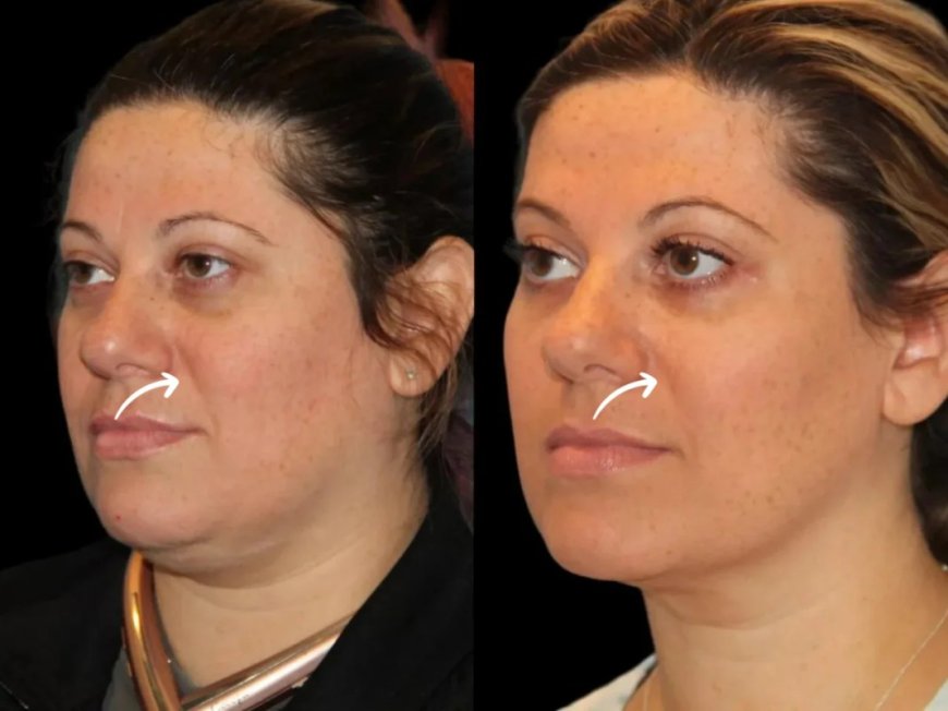 Sculptra Treatment in Dubai for Defined Contours