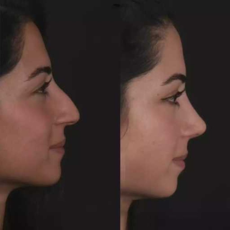 Transforming Sleep with Nose Deviated Septum Surgery in Dubai