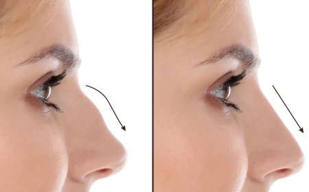 The Best Septoplasty Surgeon in Dubai: Redefining Functional Aesthetics
