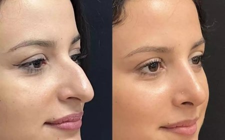From Confidence to Perfection: A Journey with the Best Rhinoplasty Surgeon in Dubai