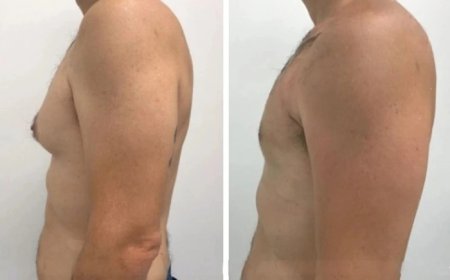 The Journey to Confidence with the Best Gynecomastia Surgeons in dubai