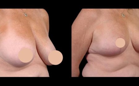 Real Stories: How Breast Reduction in Dubai Transforms Lives