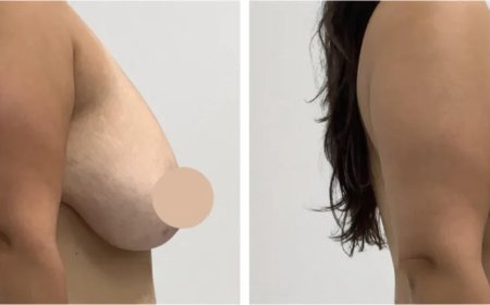 Breast Lift in Dubai A Modern Approach to Confidence