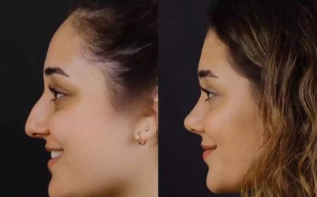 Best Septoplasty Surgeon in Dubai: Redefining Functional Nose Surgery