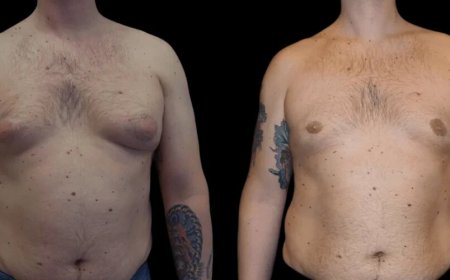What Makes the Best Gynecomastia Surgeon in dubai Stand Out