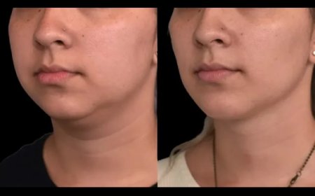 Why Trust the Best Double chin removal Surgeons in Dubai for Your Transformation