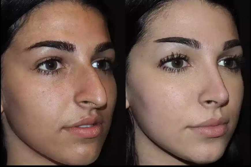 Transforming Lives One Nose at a Time: Best Rhinoplasty Surgeon in Dubai