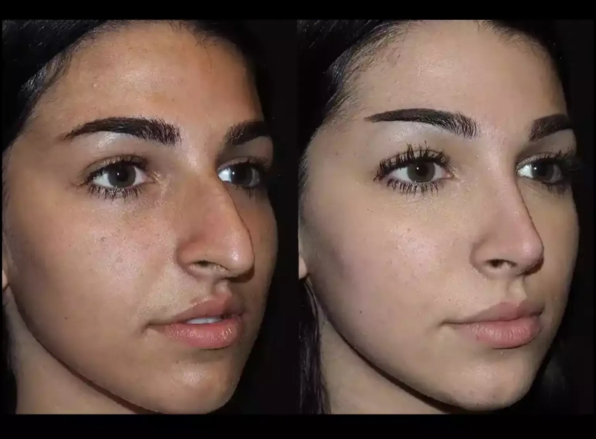 Transforming Lives One Nose at a Time: Best Rhinoplasty Surgeon in Dubai