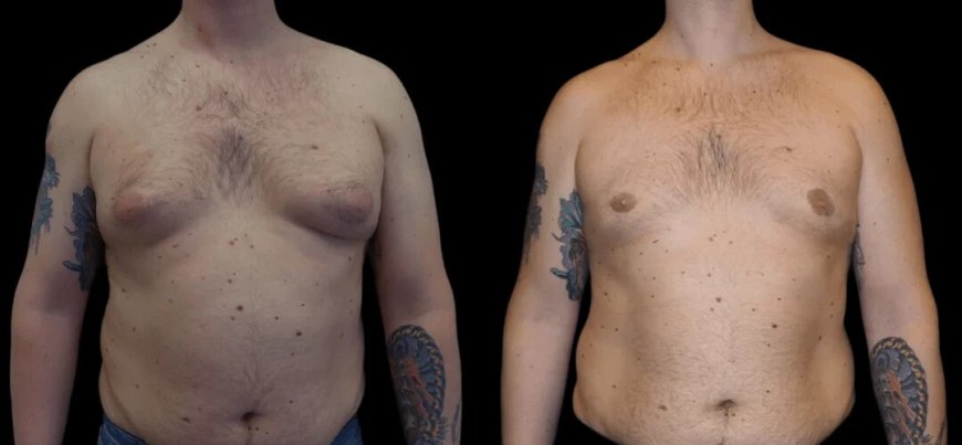 What Makes the Best Gynecomastia Surgeon in dubai Stand Out