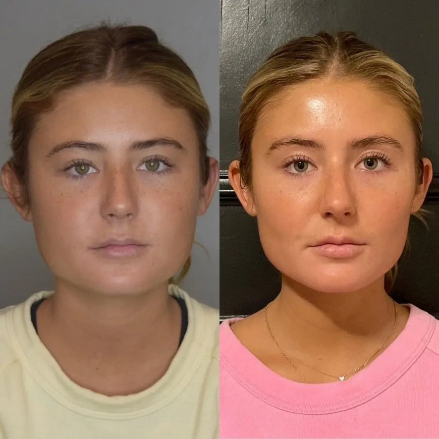 Recovery Timeline from the Best Buccal fat removal Surgeons in Dubai