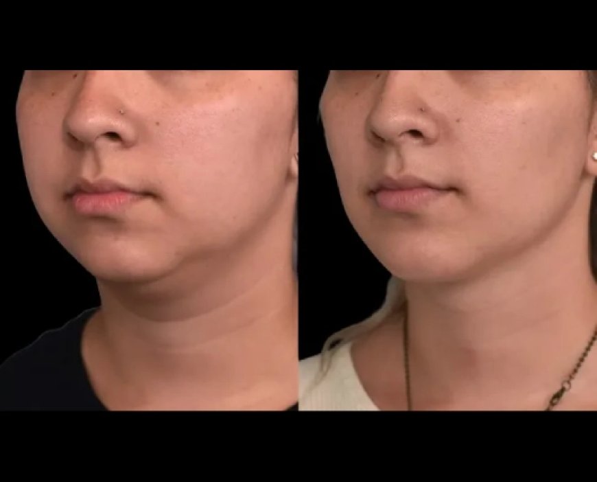 Why Trust the Best Double chin removal Surgeons in Dubai for Your Transformation
