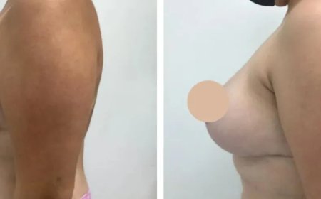 How to Prepare for Your Breast Reduction in Dubai