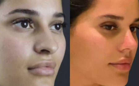 Understanding Rhinoplasty in Dubai: What Every Patient Should Know