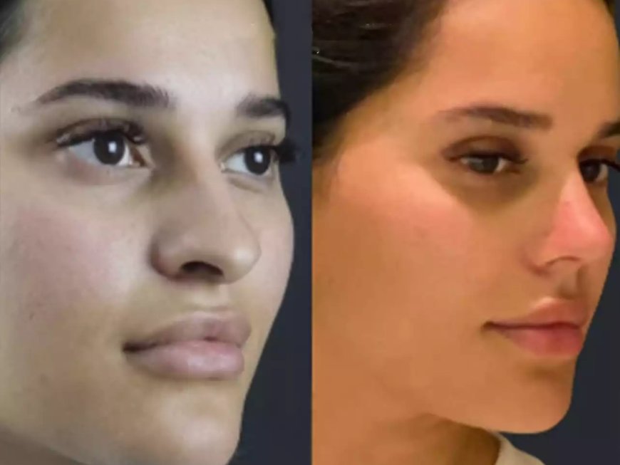Understanding Rhinoplasty in Dubai: What Every Patient Should Know