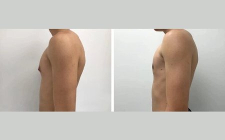 Gynecomastia Surgery in dubai: Precision, Expertise, Results