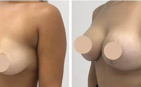 Breast Lift in Dubai: Confidence Starts with Care
