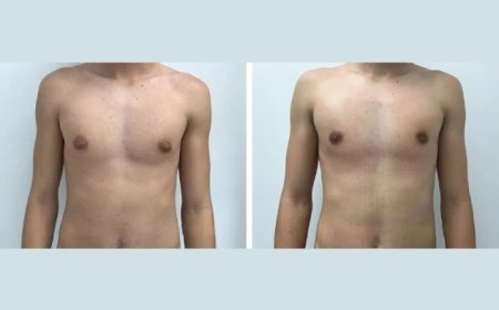 Your Guide to the Best Gynecomastia Doctors in Dubai