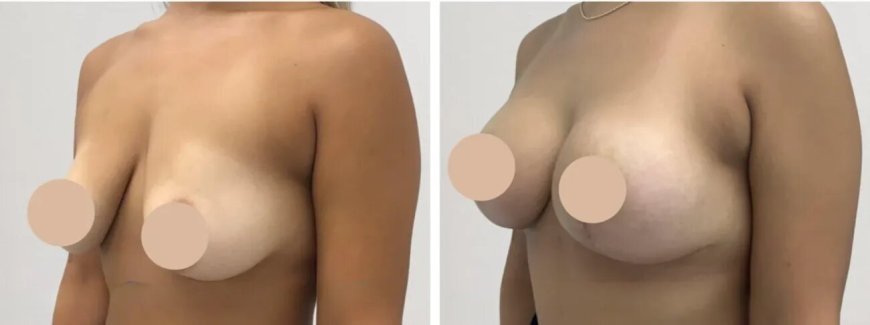 Breast Lift in Dubai: Confidence Starts with Care