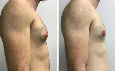 Gynecomastia Surgery in Dubai: Expert-Led Chest Contouring