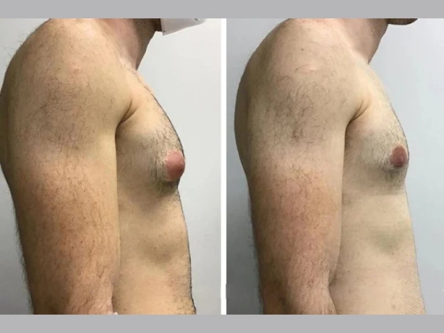 Gynecomastia Surgery in Dubai: Expert-Led Chest Contouring