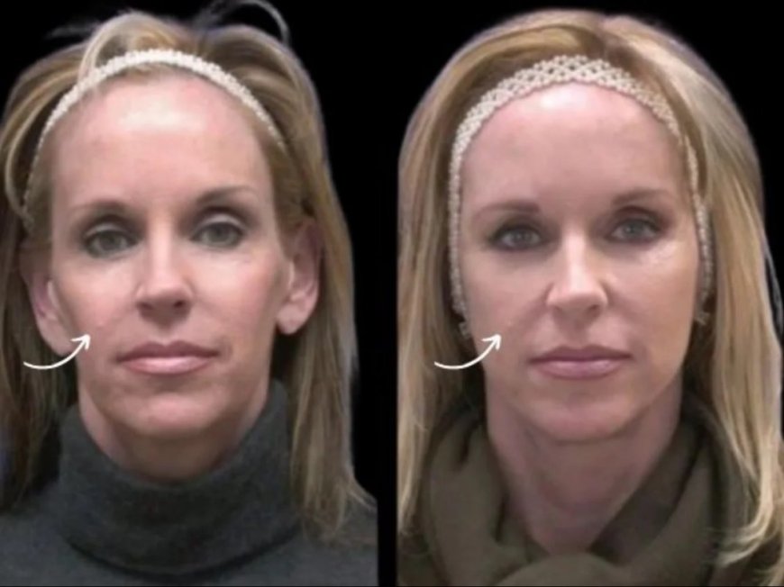 Best Plastic Surgeons in Dubai Sculptra Fillers MOH Rules